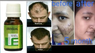 Modicare tea tree oil benefits How to use Tea tree oil [upl. by Elwyn500]