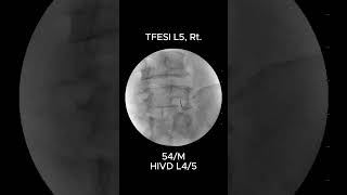 How to Accurately Perform L5 Transforaminal Epidural Steroid Injection TFESI 2 [upl. by Haerle447]