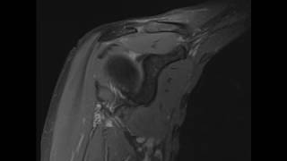 Left shoulder mri anatomy [upl. by Sidwell]