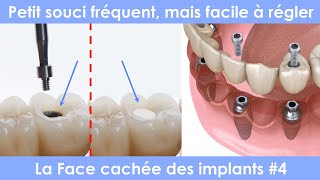 La face cachée des implants dentaires  4  Perdre un plombage composite qui cache le système vissé [upl. by Magdalen]