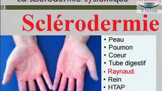 Sclerodermie systémique Symptomes et Pronostic [upl. by Jammie]