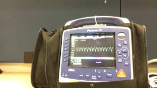 Synchronized Cardioversion with Propaq MD [upl. by Aitra9]