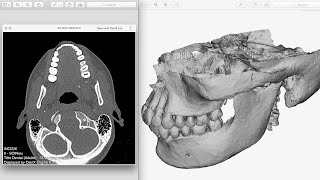 CT Scan DICOM Files to 3D HD [upl. by Earazed]