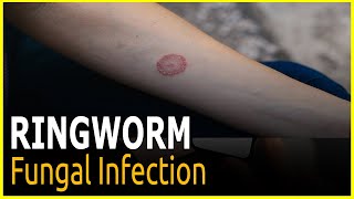 Ringworm What to know and do ringowrm treatments medicine [upl. by Aleacin]