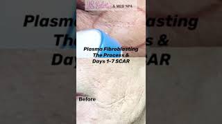 Plasma Fibroblasting SCAR Days 17 [upl. by Nolyad]