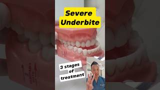 Underbite Treatment Demystified The 3 Essential Stages shorts dentallan dentist [upl. by Sirrah]