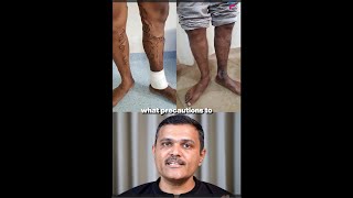 Varicose Veins EXPERT Shares Top Care Secrets After Treatment GUJARATI [upl. by Craner]