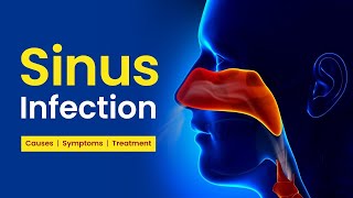 Sinus Infection Sinusitis  Causes Symptoms Treatment Options  3D Video [upl. by Yrahcaz]