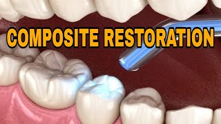 Composite Restoration For Dental Students🦷 [upl. by Trebliw]