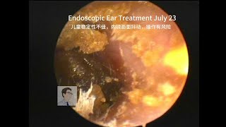 Ear wax removalCerumen embolism in children 20230723 [upl. by Beale78]