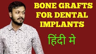 Bone grafts for dental implants  Bone grafts kya hota hai  DrVaibhav [upl. by Jewel]