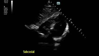 Severe Pleuritic MidChest Pain in 17 yo Boy Pneumomediastinum [upl. by Laubin]