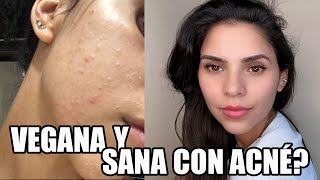 🌱 VEGANA y sana con ACNÉ 😩Como lo quité PARTE 1  Abracadabra Vegan [upl. by Enelahs]