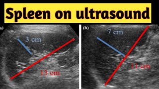 Spleen☑️How to measure spleen splenic Index  Radiology vibes [upl. by Amapuna]