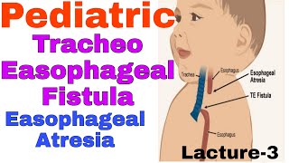 Tracheoesophageal fistula in hindiEsophageal Atresia  TEF EA  staff nurse online classes [upl. by Lemmie229]