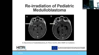 Radiation treatment plan for pediatric cancer a clinical view George Giakoumettis AUTH AHEPA [upl. by Ettennej]