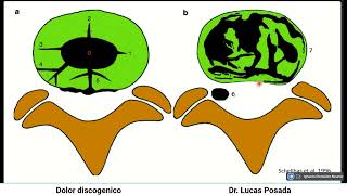 Dolor discogénico [upl. by Ahsap862]