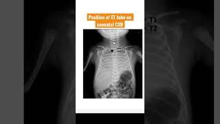 Position of ET tube on neonatal CXR ETtube endotrachealintubation NICU [upl. by Gnuoy]