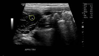 Appendix between RT External and Internal Iliac artery [upl. by Halbert]