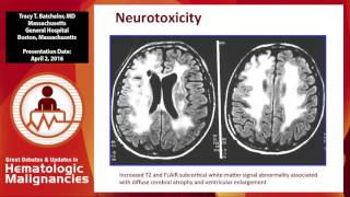 Update in primary CNS lymphoma management [upl. by Hebrew437]