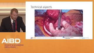 IBD Surgery Debate 1 Ileocecal Crohns disease [upl. by Kristos]