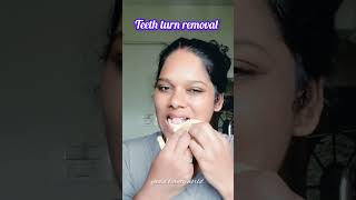 Unga pallu majal ha Eruka appo indha method use pannuga teeth teethwhitening beutyhack yadvi [upl. by Myke]