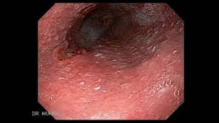 Esofagitis infecciosa por Citomegalovirus [upl. by Adriana]