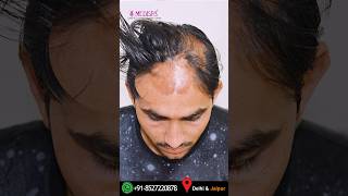 Hair Transplant Results in Burn Cases by Dr Suneet Soni at Medispa Centre costofhairtransplant [upl. by Atcliffe]