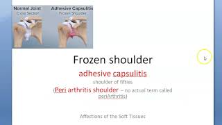 Orthopedics 323 Frozen Shoulder Arthritis adhesive capsulitis shoulder [upl. by Moriyama]