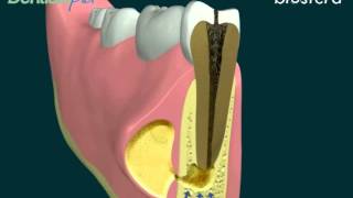 Ascesso la terapia endodontica [upl. by Gannie706]