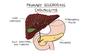 Primary Sclerosing Cholangitis Visual Explanation for Students [upl. by Hooge]