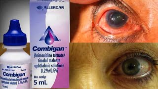 Combigan Eye Drop For Ocular Hypertension glaucoma  Brimonidine  Timolo [upl. by Haeli390]