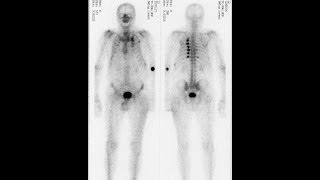 Was ist eine Osteomyelitis [upl. by Lednik244]