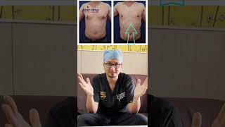 Gynecomastia Surgery Recovery Made EASY with Compression Garments [upl. by Sedgewick751]