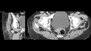 Trochanteric bursitis  CT findings [upl. by Nyrac488]