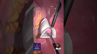 doctor remove tissues laparoscopic 3danimationsurgery medicalanimation hospital [upl. by Ialda]