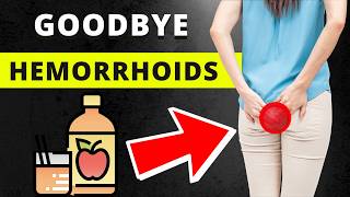 7 Home Remedies to Get Rid of Hemorrhoids and Prevent Them [upl. by Gris]