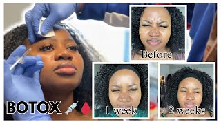 The surprising result of my BOTOX treatment [upl. by Fessuoy]