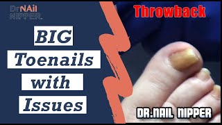 How to Treat a Big Toenail What is onycholysis Toenails with Issues [upl. by Endaira]