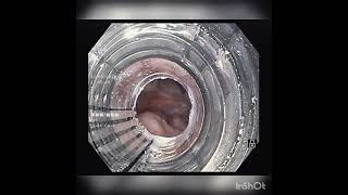 Esophageal variceal banding for grade3 esophageal varices [upl. by Ferro]