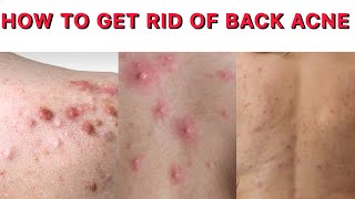 POWERFUL REMEDY FOR BACK ACNE  HOME REMEDY TO GET RID OF BACK ACNE  BACK ACNE SOLUTION [upl. by Dominga]