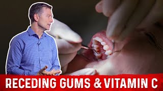 Receding Gums and Vitamin C Explained By DrBerg [upl. by Trella382]