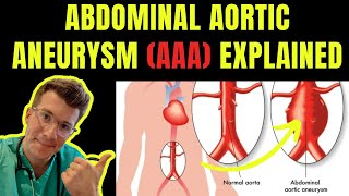 Doctor explains ABDOMINAL AORTIC ANEURYSM AAA  Symptoms risk factors treatment screening [upl. by Aremaj]