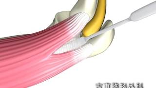 肘部管症候群の日帰り手術のイメージ動画 古東整形外科 [upl. by Bakki614]