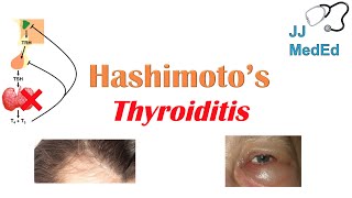 Hashimoto’s thyroiditis What Is It Whos At Risk and What You NEED to Know [upl. by Nomla]