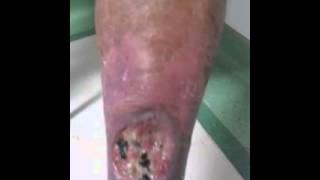 Venous leg ulcer [upl. by Haldi]