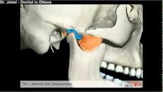 Oral Surgery  TMJ Anterior Disc Displacement  Ottawa Dentist [upl. by Stent462]