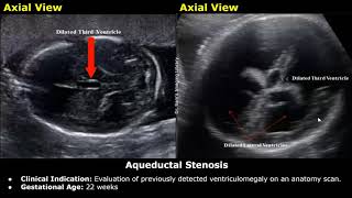 Fetal Brain Ultrasound Reporting  Obstetric Brain Pathologies Scan Reports  Pregnancy USG [upl. by Aitas]