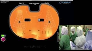 VERASENSE Reevaluating Balance After Cementation  Smith amp Nephew Journey II [upl. by Einhoj]