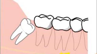 alte Version Erklärung spezieller Probleme und Risiken bei der Weisheitszahnentfernung [upl. by Ahsal278]